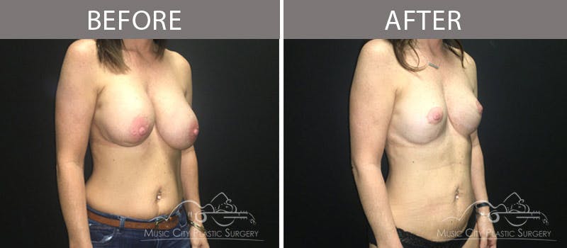 Capsulectomy Before & After Gallery - Patient 90705062 - Image 3