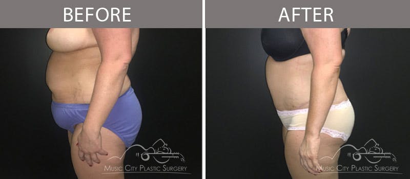 Abdominoplasty Before & After Gallery - Patient 90705063 - Image 3
