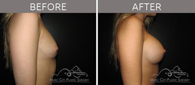 Breast Augmentation Before & After Gallery - Patient 90705070 - Image 3