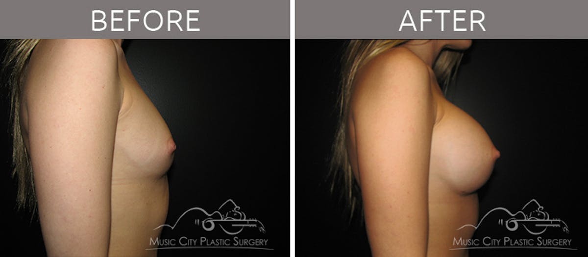 Breast Augmentation Before & After Gallery - Patient 90705070 - Image 3