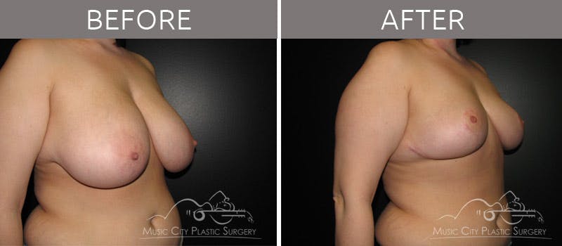 Breast Reduction with Lift Before & After Gallery - Patient 132099796 - Image 3