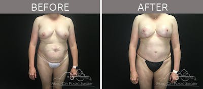 Mommy Makeover Before & After Gallery - Patient 90705069 - Image 1