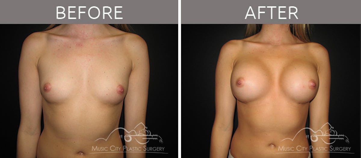 Breast Augmentation Before & After Gallery - Patient 90705070 - Image 1