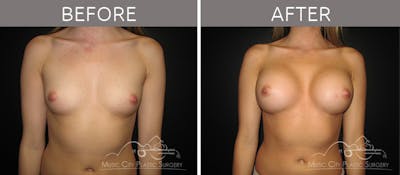 Breast Augmentation Before & After Gallery - Patient 90705070 - Image 3