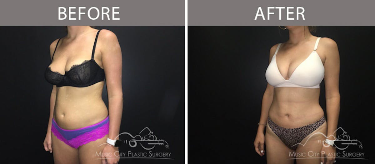 Liposuction Before & After Gallery - Patient 90705065 - Image 1