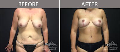 Abdominoplasty Before & After Gallery - Patient 90705072 - Image 1