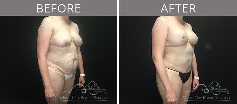 Mommy Makeover Before & After Gallery - Patient 90705069 - Image 4