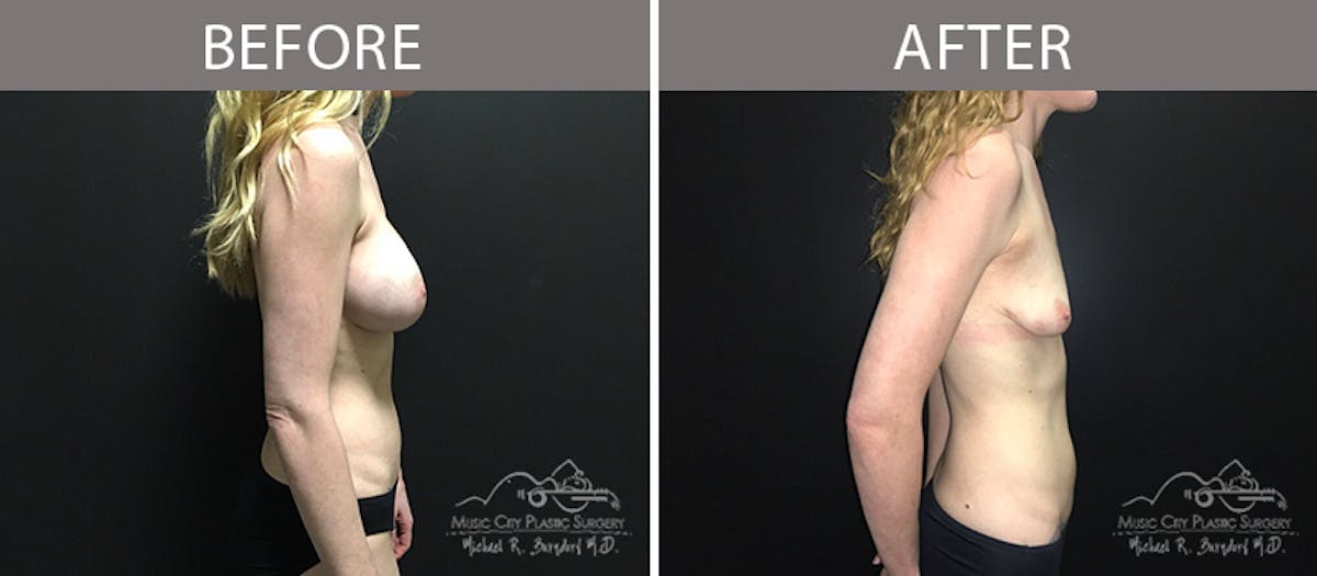 Capsulectomy Before & After Gallery - Patient 90705074 - Image 3