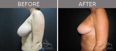 Breast Reduction with Lift Before & After Gallery - Patient 132099795 - Image 3