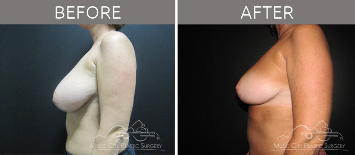 Breast Reduction with Lift Before & After Gallery - Patient 132099795 - Image 3