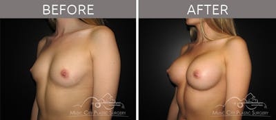 Breast Augmentation Before & After Gallery - Patient 90705070 - Image 2