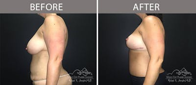 Abdominoplasty Before & After Gallery - Patient 90705072 - Image 3