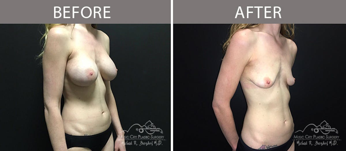 Capsulectomy Before & After Gallery - Patient 90705074 - Image 2