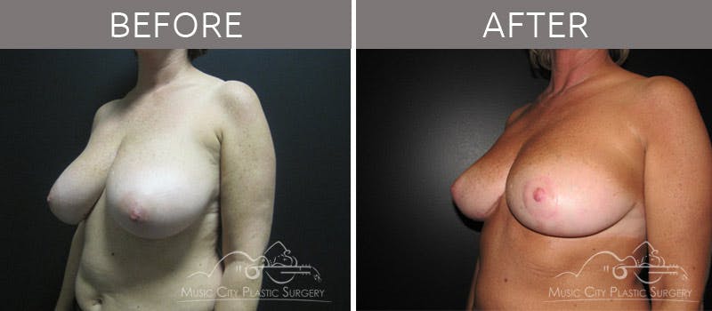 Breast Reduction with Lift Before & After Gallery - Patient 132099795 - Image 2
