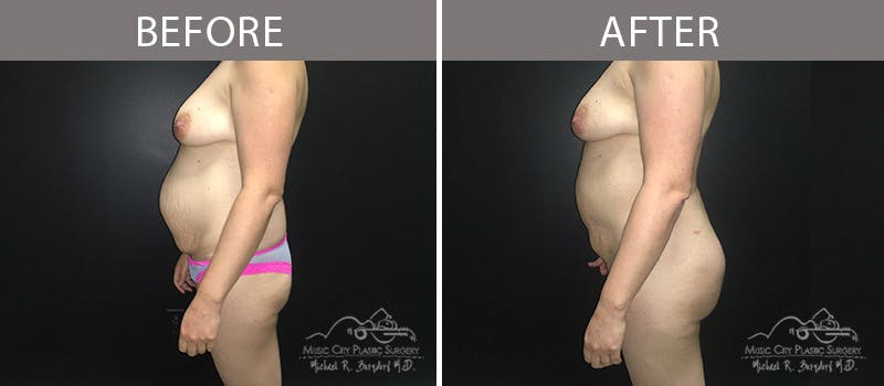 Liposuction Before & After Gallery - Patient 90705078 - Image 1