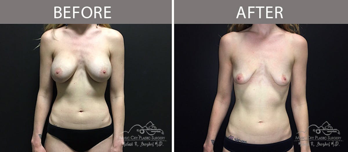 Capsulectomy Before & After Gallery - Patient 90705074 - Image 1