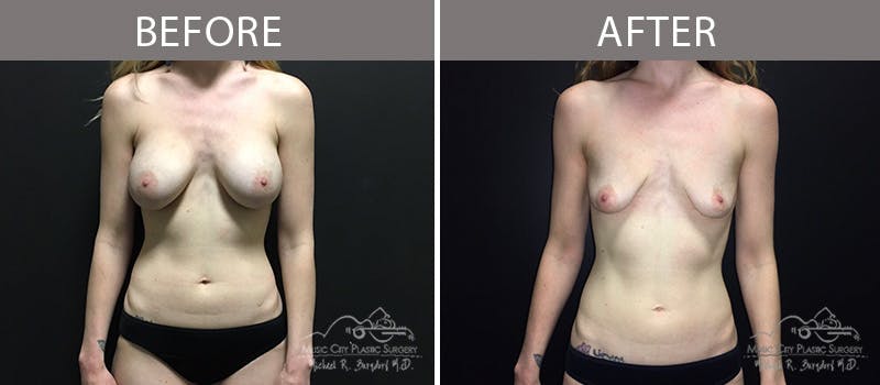 Capsulectomy Before & After Gallery - Patient 90705074 - Image 3