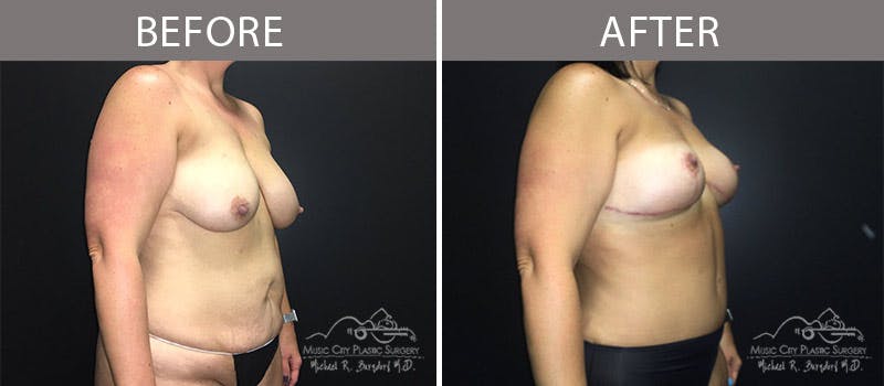 Abdominoplasty Before & After Gallery - Patient 90705072 - Image 3