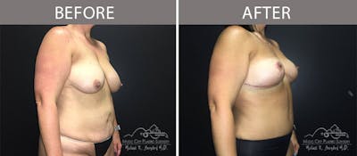 Abdominoplasty Before & After Gallery - Patient 90705072 - Image 2