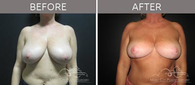Breast Reduction with Lift Before & After Gallery - Patient 132099795 - Image 1