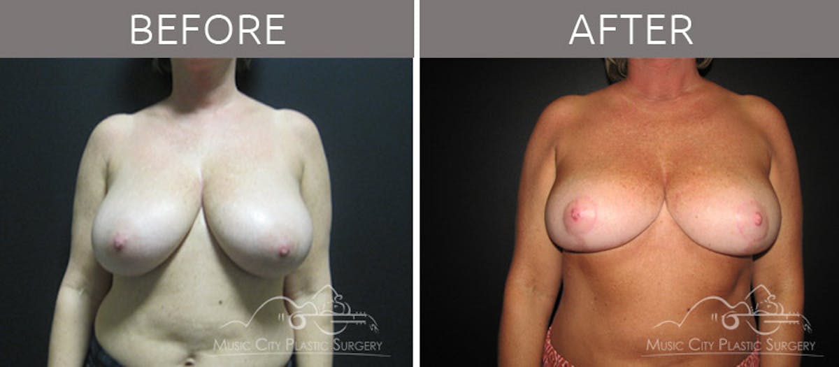 Breast Reduction with Lift Before & After Gallery - Patient 132099795 - Image 1