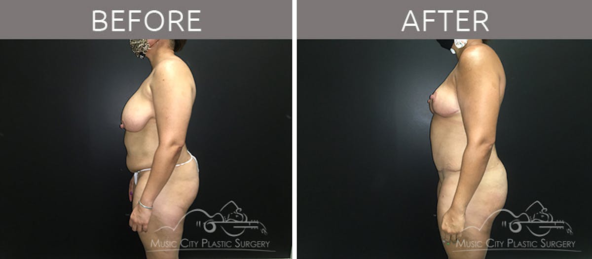 Mommy Makeover Before & After Gallery - Patient 90705086 - Image 3