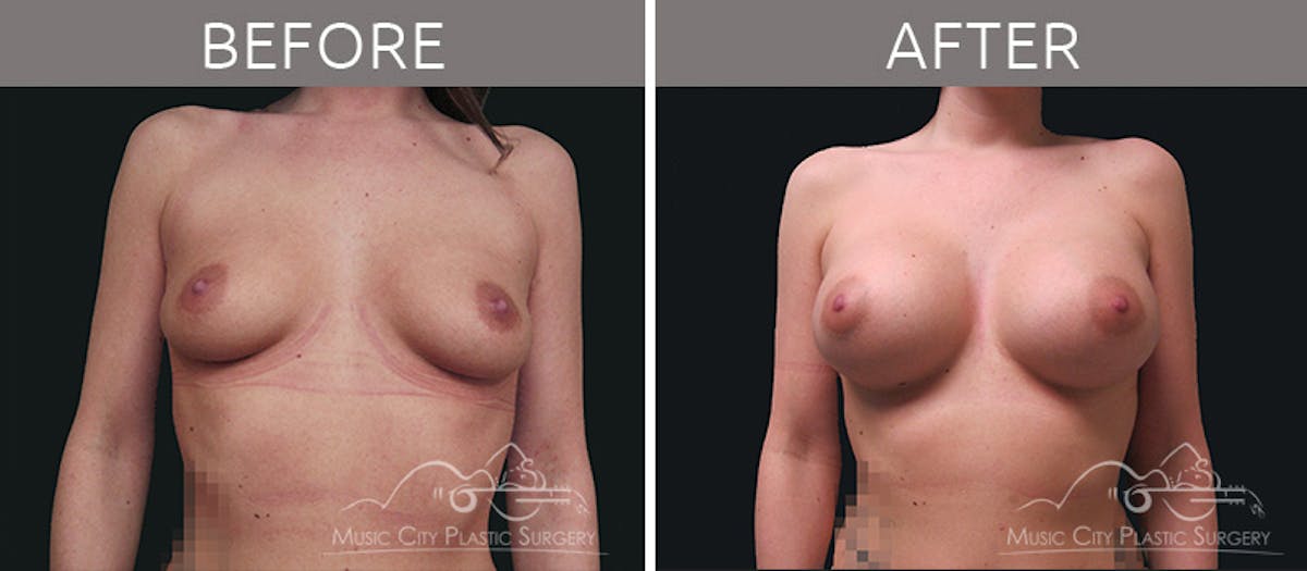 Breast Augmentation Before & After Gallery - Patient 90705080 - Image 1