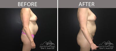 Brazilian Butt Lift Before & After Gallery - Patient 142952 - Image 3