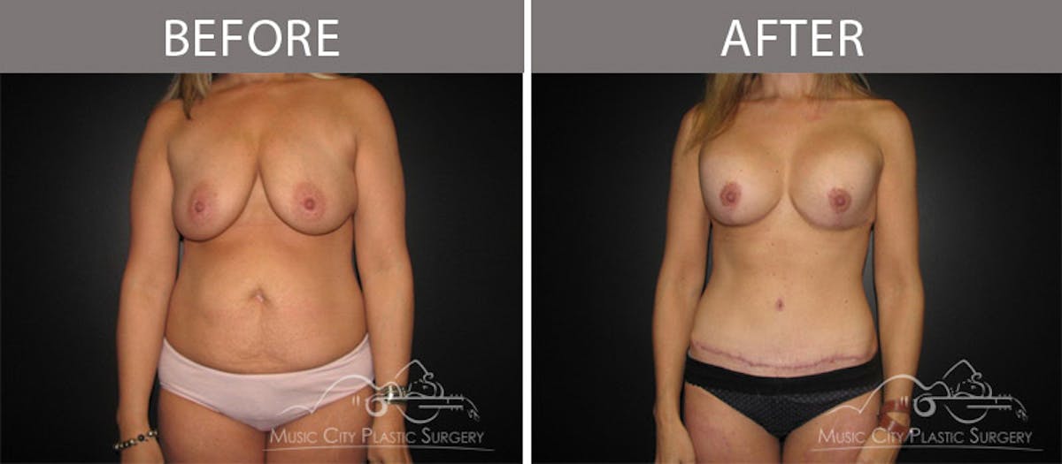 Abdominoplasty Before & After Gallery - Patient 90705083 - Image 1