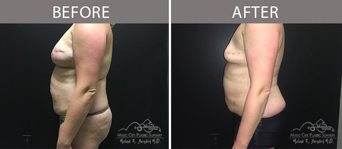 Capsulectomy Before & After Gallery - Patient 90705081 - Image 2