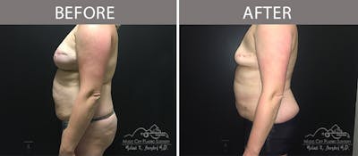 Capsulectomy Before & After Gallery - Patient 90705081 - Image 2