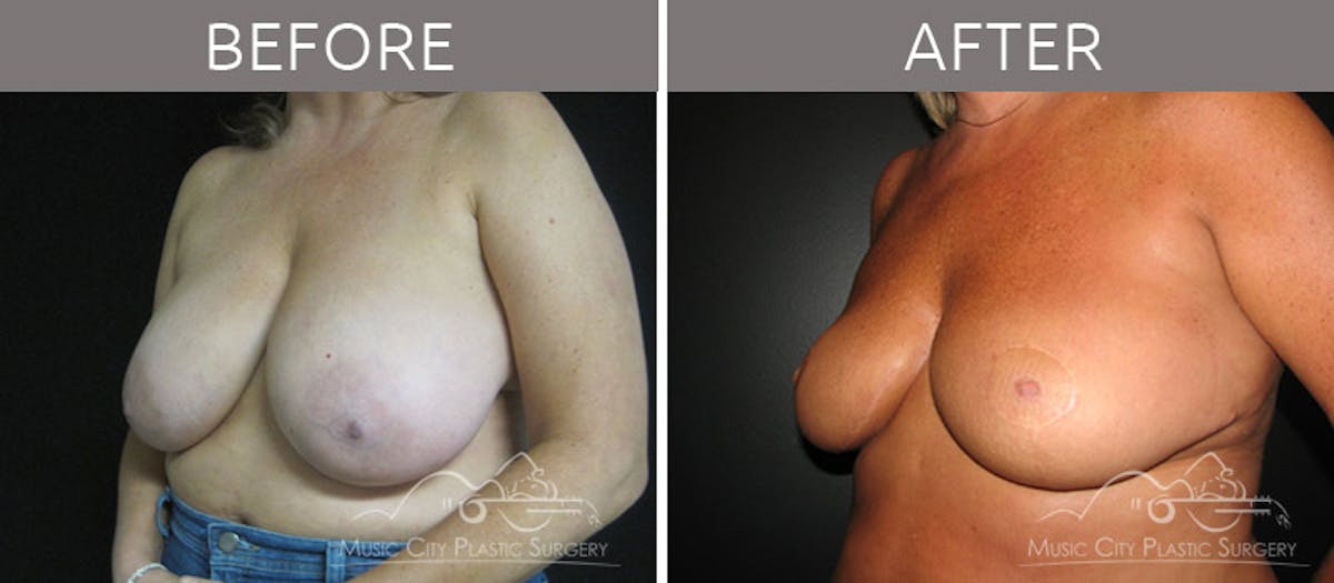 Breast Reduction with Lift Before & After Gallery - Patient 132099794 - Image 2