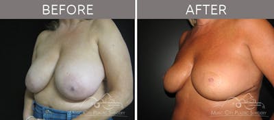 Breast Reduction with Lift Before & After Gallery - Patient 132099794 - Image 2