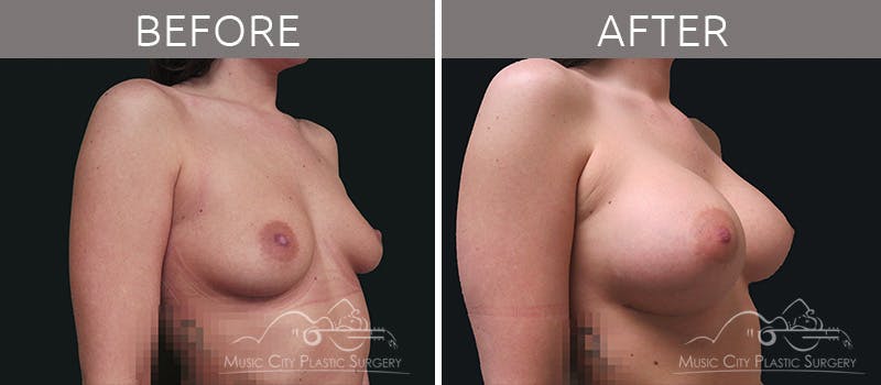 Breast Augmentation Before & After Gallery - Patient 90705080 - Image 2