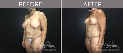 Mommy Makeover Before & After Gallery - Patient 90705086 - Image 2