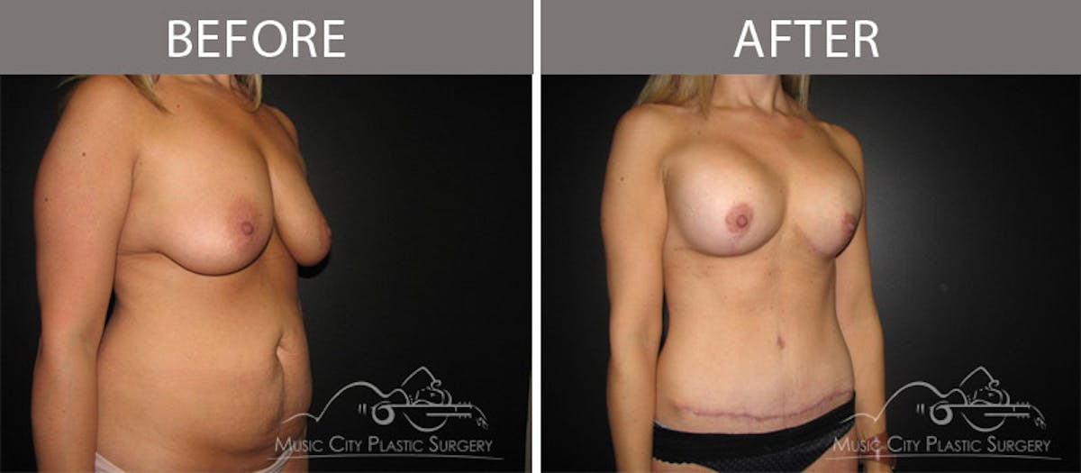 Abdominoplasty Before & After Gallery - Patient 90705083 - Image 2