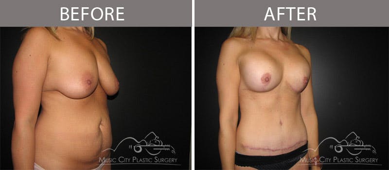 Abdominoplasty Before & After Gallery - Patient 90705083 - Image 2