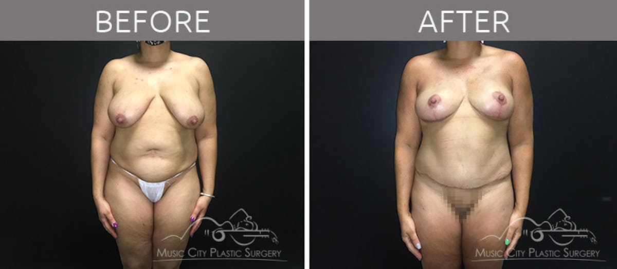 Mommy Makeover Before & After Gallery - Patient 90705086 - Image 1