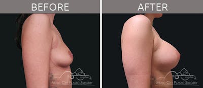 Breast Augmentation Before & After Gallery - Patient 90705080 - Image 3