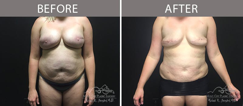Capsulectomy Before & After Gallery - Patient 90705081 - Image 2