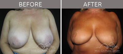 Breast Reduction with Lift Before & After Gallery - Patient 132099794 - Image 1