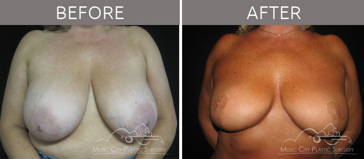 Breast Reduction with Lift Before & After Gallery - Patient 132099794 - Image 1