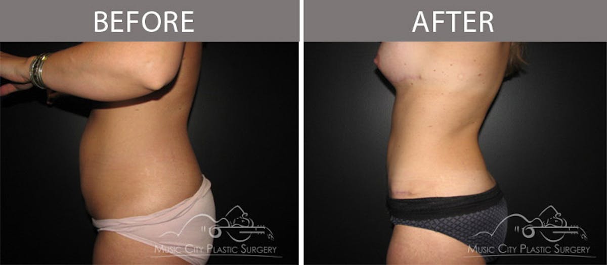 Abdominoplasty Before & After Gallery - Patient 90705083 - Image 4