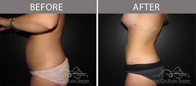 Abdominoplasty Before & After Gallery - Patient 90705083 - Image 3