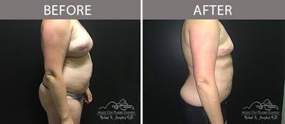 Capsulectomy Before & After Gallery - Patient 90705081 - Image 3
