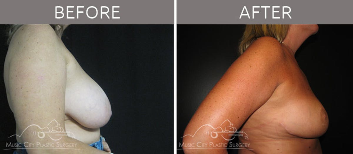 Breast Reduction with Lift Before & After Gallery - Patient 132099794 - Image 3