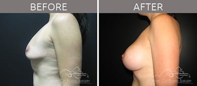 Breast Augmentation Before & After Gallery - Patient 90705087 - Image 3
