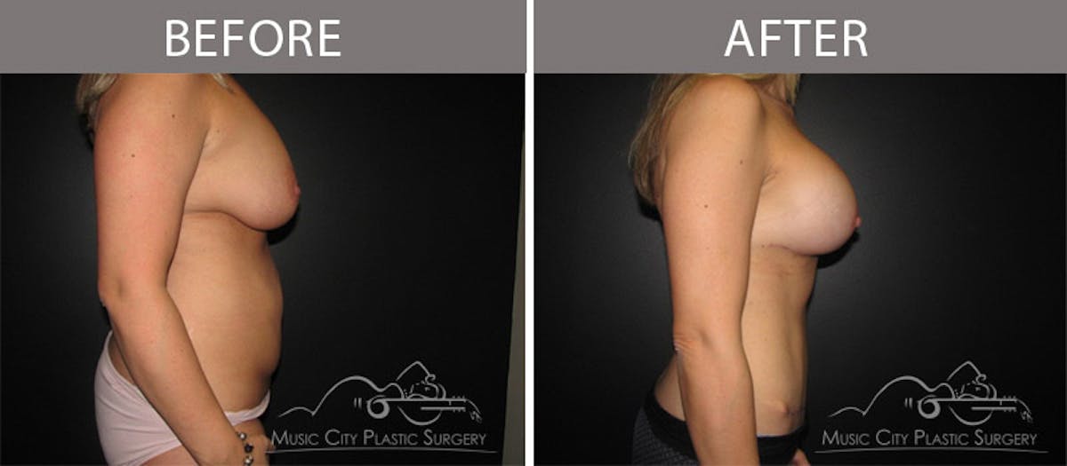 Abdominoplasty Before & After Gallery - Patient 90705083 - Image 3