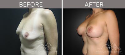 Breast Augmentation Before & After Gallery - Patient 90705087 - Image 2