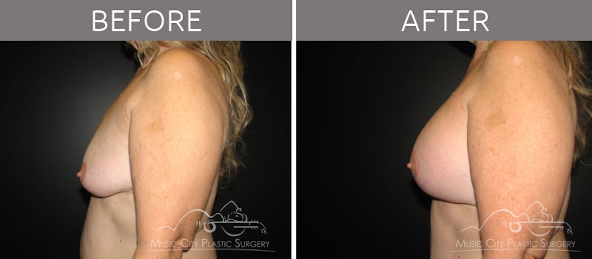 Breast Lift with Augmentation Before & After Gallery - Patient 132099630 - Image 3